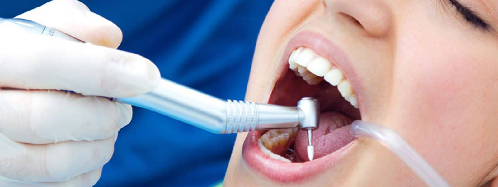 broken tooth dentist treatment kallangur